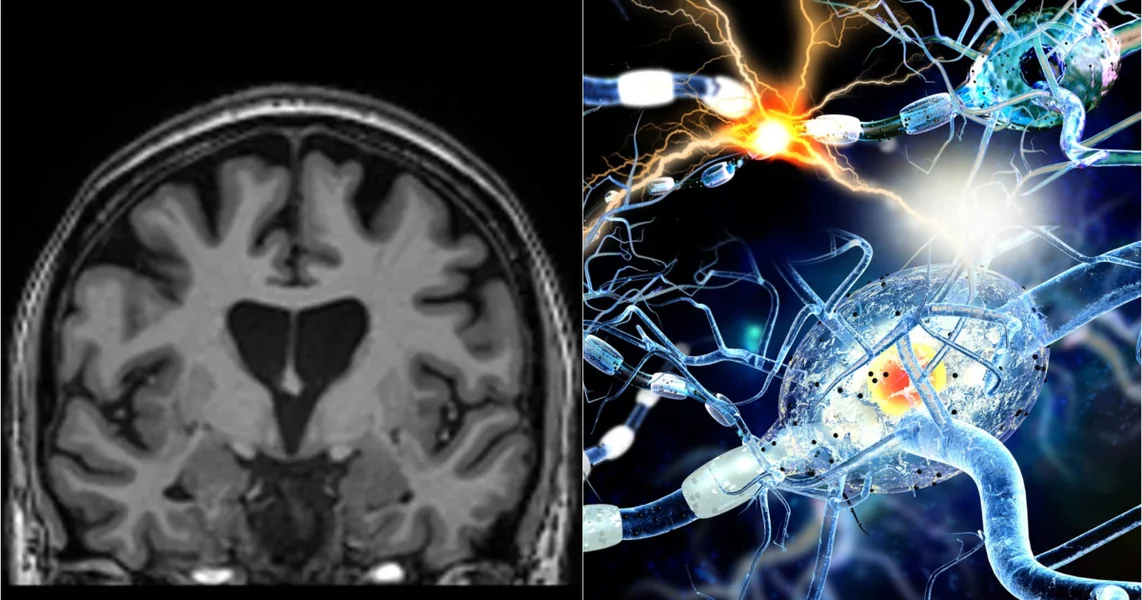 Studija: COVID-19 može ostaviti detektabilne promene u mozgu, čak i nakon potpunog oporavka