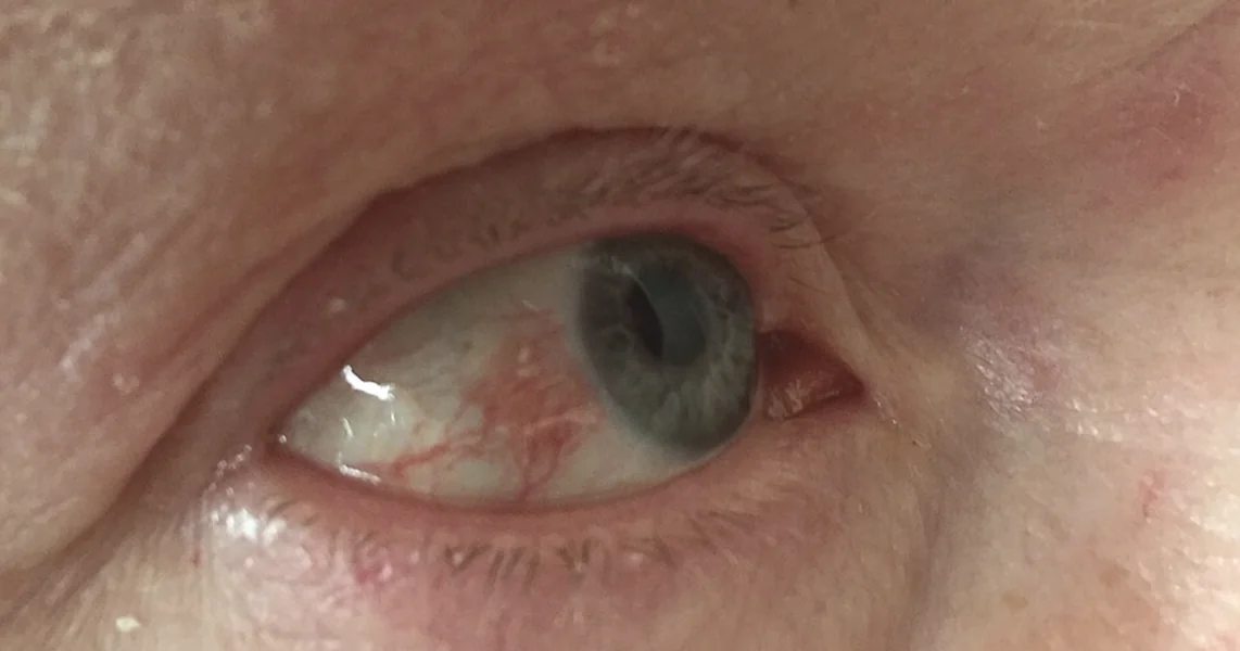 Opasan virus sve češće ugrožava vid Hrvata: Splitčanin ostao bez oka jer su mislili da je benigno
