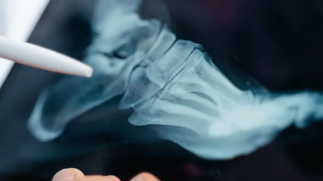 Osteoporoza: bolest koja može godinama neprimetno da uništava kosti – mnogi se suočavaju tek kada je prekasno