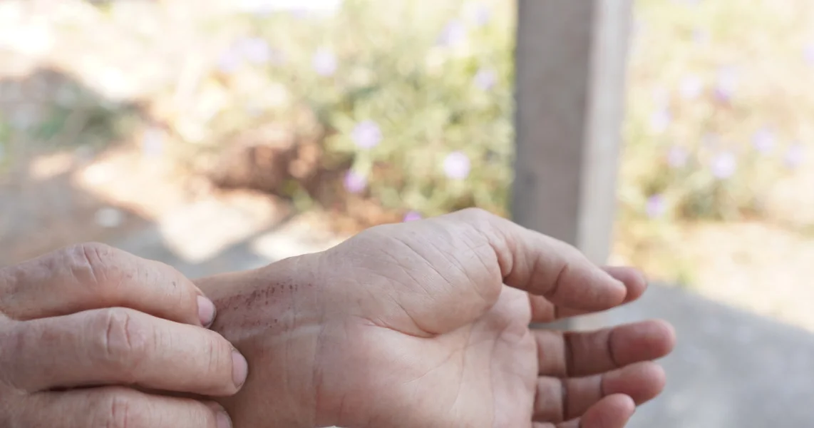 Slučajevi šuge otkriveni u Psihijatrijskoj bolnici u Džebelu. DSP Timis pokrenuo istragu