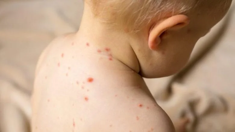 Još jedan slučaj morbila u Albaniji, trogodišnje dete koje nije vakcinisano smešteno na pedijatriju infektivne bolesti! Tokom godine registrovano je 18 slučajeva - Shqiptarja.com